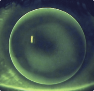 Irregular Cornea - Ideal Fit