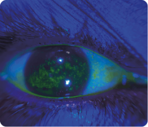 Keratitis Superficial Punctata