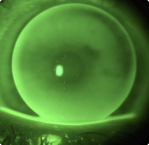 Regular Cornea – Flat Adaptation