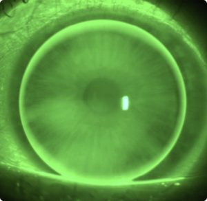 Regular Cornea  – Ideal Fit