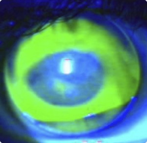 Irregular Cornea